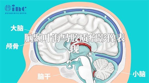 脑颞叶海马胶质瘤影像表现