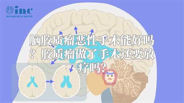 脑胶质瘤恶性手术能好吗？胶质瘤做了手术还要放疗吗？