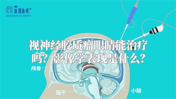 视神经胶质瘤眼睛能治疗吗？影像学表现是什么？