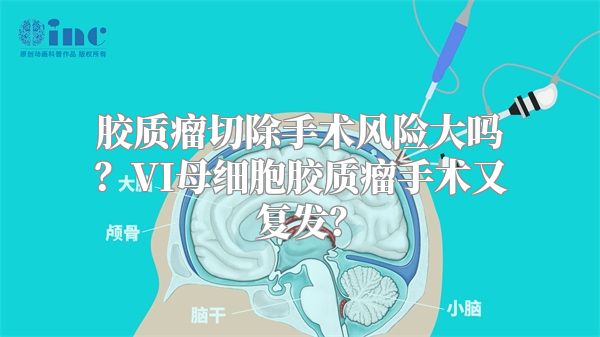 胶质瘤切除手术风险大吗？VI母细胞胶质瘤手术又复发？