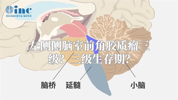 左侧侧脑室前角胶质瘤三级？三级生存期？