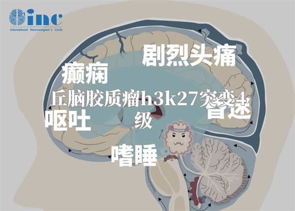 丘脑胶质瘤h3k27突变4级  