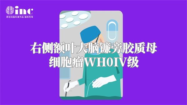 右侧额叶大脑镰旁胶质母细胞瘤WH0IV级