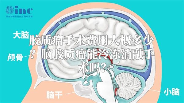 胶质瘤手术费用大概多少？脑胶质瘤能冷冻消融手术吗？