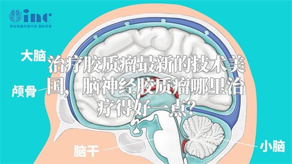 治疗胶质瘤最新的技术美国，脑神经胶质瘤哪里治疗得好一点？