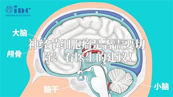 神经节细胞瘤是否需要切除？看医生的建议！