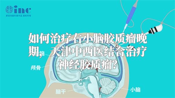 如何治疗右小脑胶质瘤晚期，天津中西医结合治疗神经胶质瘤？