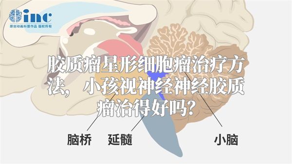 胶质瘤星形细胞瘤治疗方法，小孩视神经神经胶质瘤治得好吗？