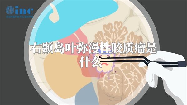 右颞岛叶弥漫性胶质瘤是什么  