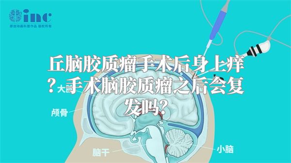 丘脑胶质瘤手术后身上痒？手术脑胶质瘤之后会复发吗？