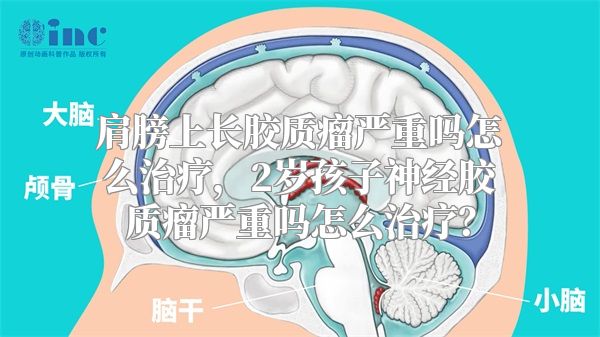 肩膀上长胶质瘤严重吗怎么治疗，2岁孩子神经胶质瘤严重吗怎么治疗？