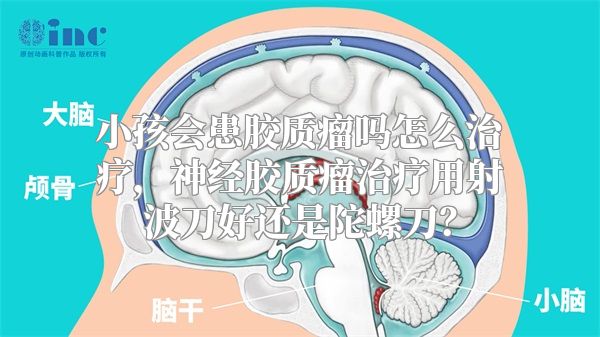 小孩会患胶质瘤吗怎么治疗，神经胶质瘤治疗用射波刀好还是陀螺刀？