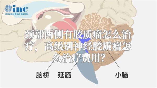 颈部两侧有胶质瘤怎么治疗，高级别神经胶质瘤怎么治疗费用？