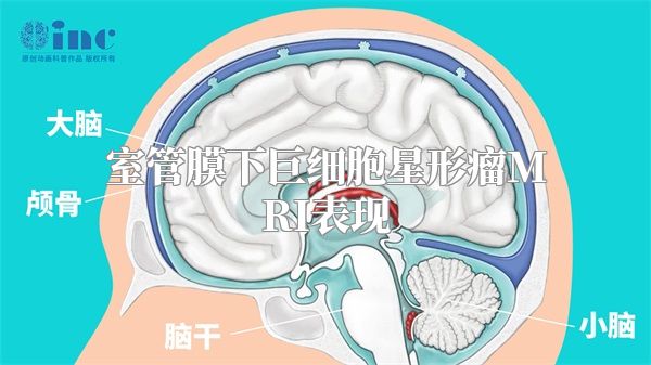 室管膜下巨细胞星形瘤MRI表现