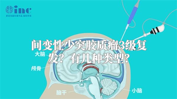 间变性少突胶质瘤3级复发？有几种类型？