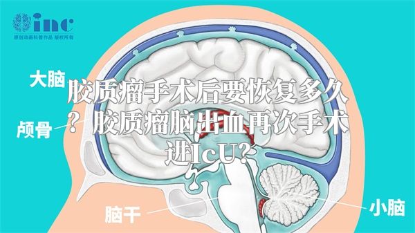 胶质瘤手术后要恢复多久？胶质瘤脑出血再次手术进IcU？