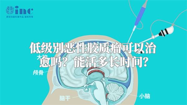 低级别恶性胶质瘤可以治愈吗？能活多长时间？