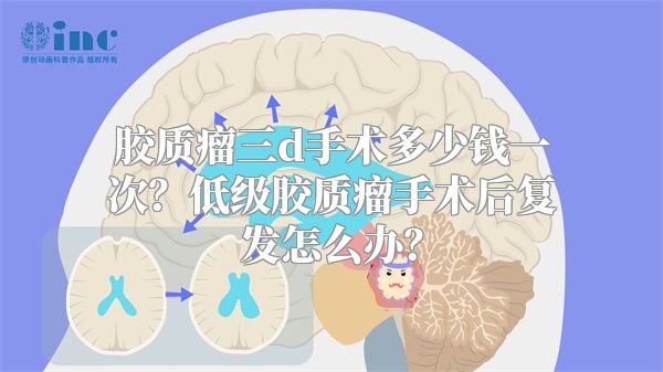 胶质瘤三d手术多少钱一次？低级胶质瘤手术后复发怎么办？