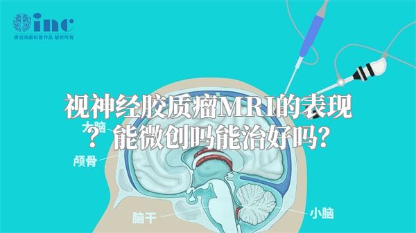 视神经胶质瘤MRI的表现？能微创吗能治好吗？