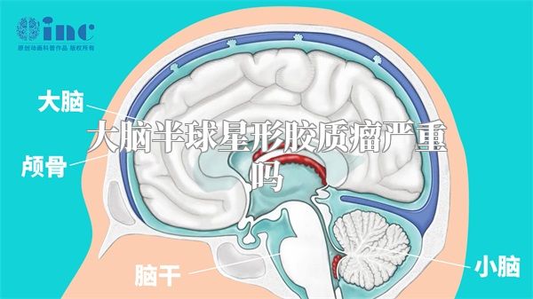 大脑半球星形胶质瘤严重吗