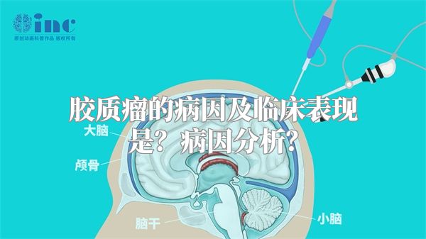 胶质瘤的病因及临床表现是？病因分析？