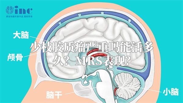 少枝胶质瘤严重吗能活多久？MRS表现？