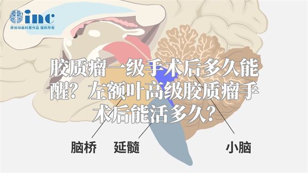 胶质瘤一级手术后多久能醒？左额叶高级胶质瘤手术后能活多久？