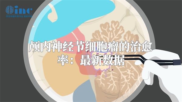 颅内神经节细胞瘤的治愈率：最新数据