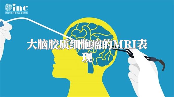 大脑胶质细胞瘤的MRI表现