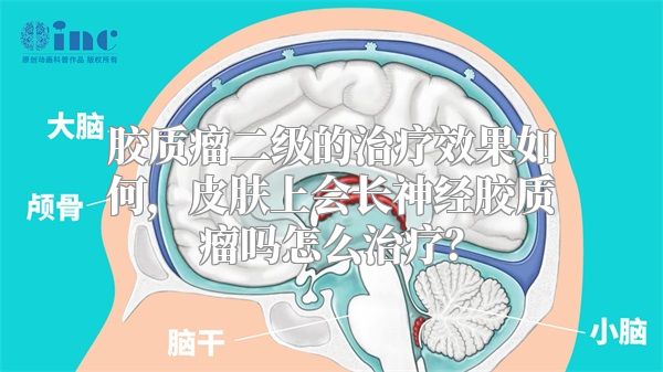 胶质瘤二级的治疗效果如何，皮肤上会长神经胶质瘤吗怎么治疗？