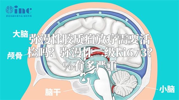 弥漫性胶质瘤放疗需要活检吗？弥漫性二级ki673？%有多严重