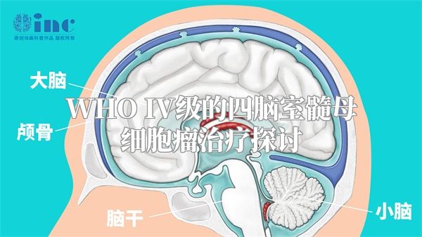 WHO IV级的四脑室髓母细胞瘤治疗探讨