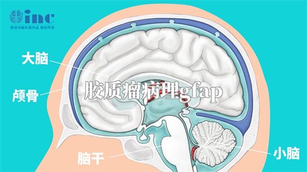 胶质瘤病理gfap