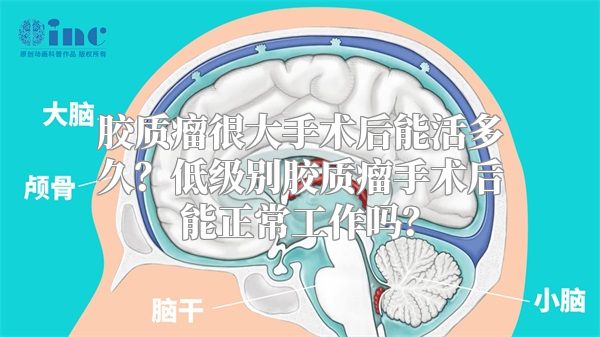 胶质瘤很大手术后能活多久？低级别胶质瘤手术后能正常工作吗？