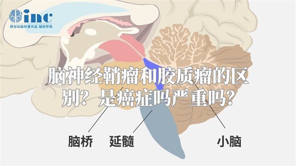 脑神经鞘瘤和胶质瘤的区别？是癌症吗严重吗？