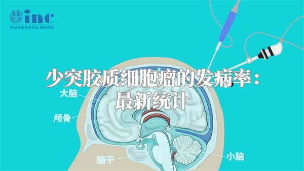 少突胶质细胞瘤的发病率：最新统计