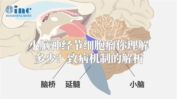 小脑神经节细胞瘤你理解多少？致病机制的解析