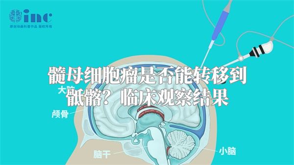 髓母细胞瘤是否能转移到骶髂？临床观察结果