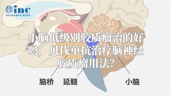 小脑低级别胶质瘤治的好吗，贝伐单抗治疗脑神经胶质瘤用法？