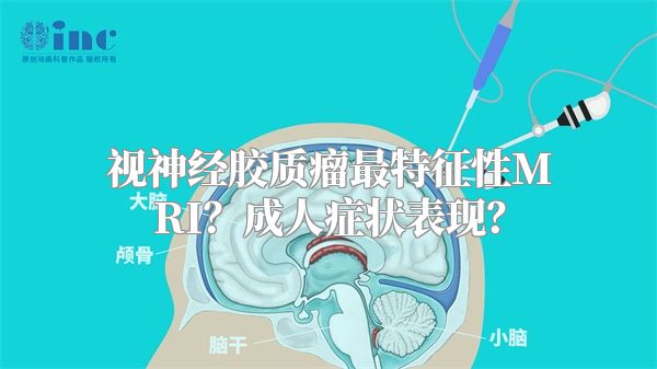 视神经胶质瘤最特征性MRI？成人症状表现？