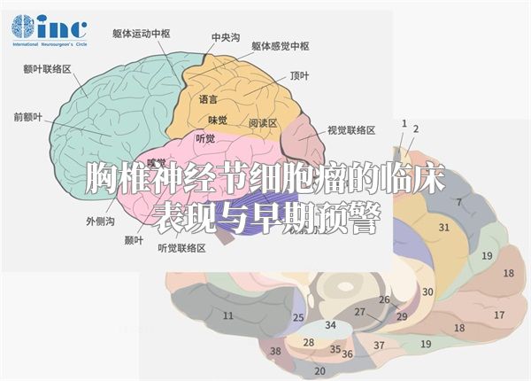 胸椎神经节细胞瘤的临床表现与早期预警