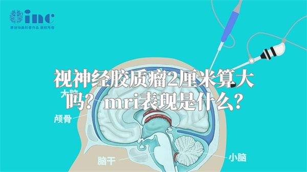 视神经胶质瘤2厘米算大吗？mri表现是什么？