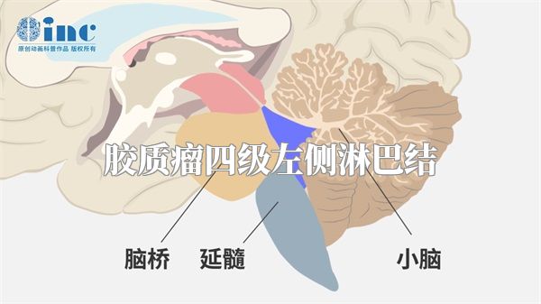 胶质瘤四级左侧淋巴结