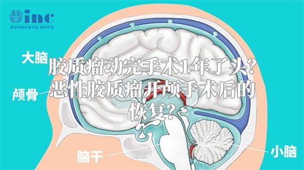 胶质瘤动完手术1年了头？恶性胶质瘤开颅手术后的恢复？