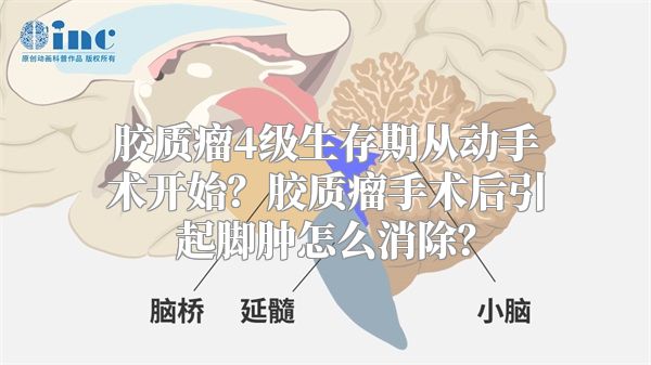 胶质瘤4级生存期从动手术开始？胶质瘤手术后引起脚肿怎么消除？