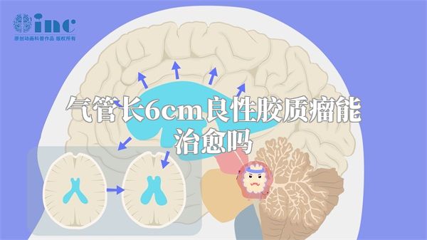 气管长6cm良性胶质瘤能治愈吗