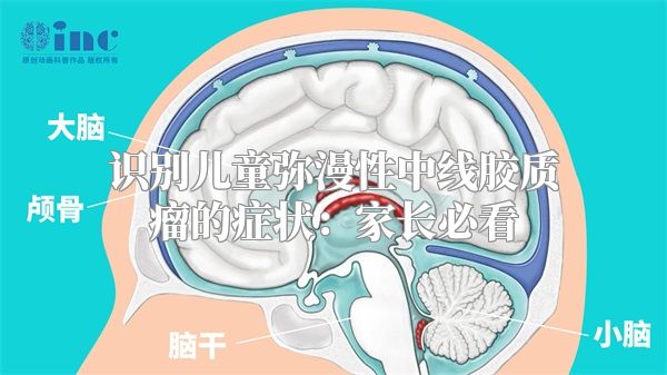 识别儿童弥漫性中线胶质瘤的症状：家长必看