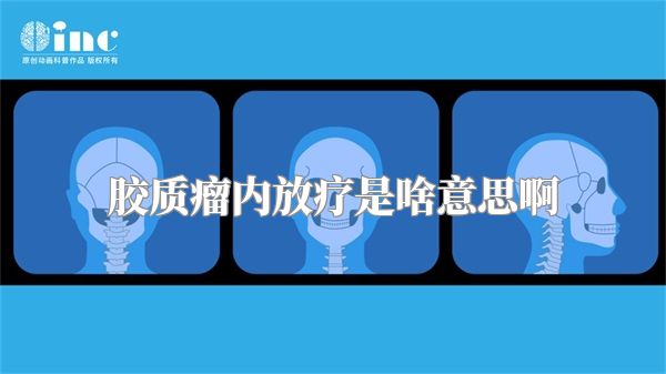 胶质瘤内放疗是啥意思啊