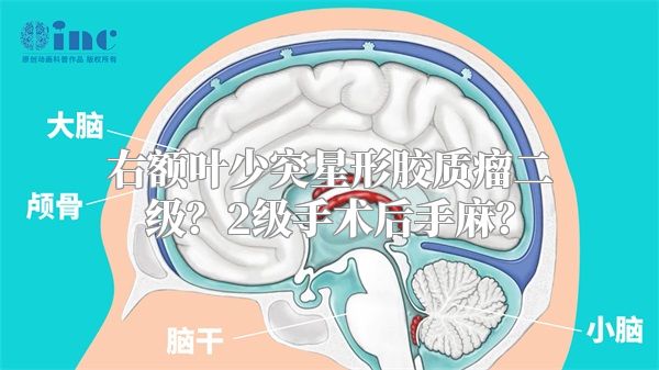 右额叶少突星形胶质瘤二级？2级手术后手麻？