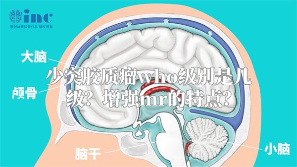 少突胶质瘤who级别是几级？增强mr的特点？